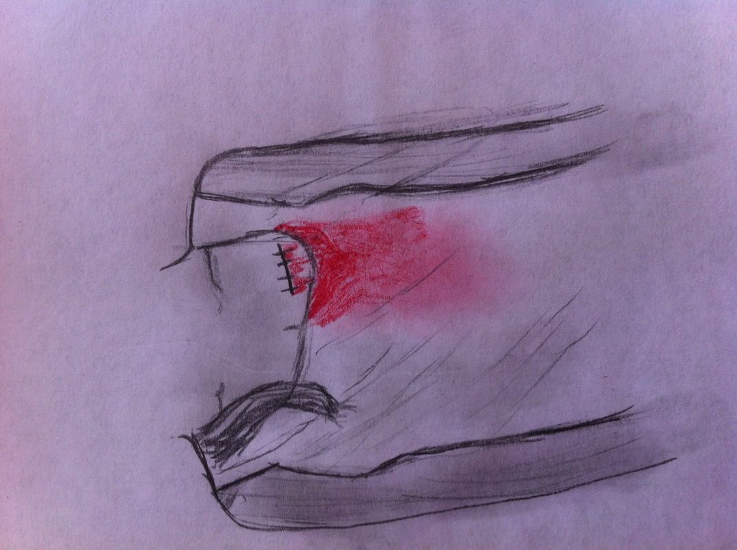 Torn heart