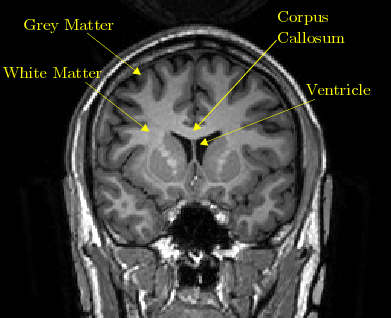 Grey matter Grey matter