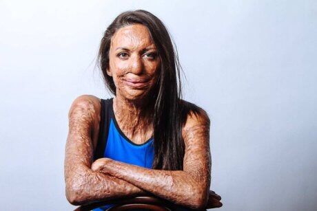 The inner smile - a story of courage of a burn "victim" The inner smile - a story of courage of a burn "victim"
