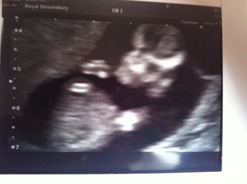 baby bump