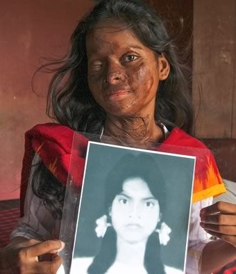 Courage and the woman who was the victim of an acid attack 
