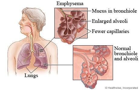 Emphysema