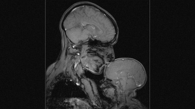 Wellbutrin in my Brain