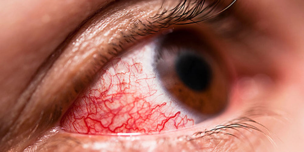 Eye-Strain