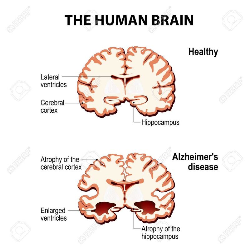 THE FIRST STAGES OF ALZHEIMERS