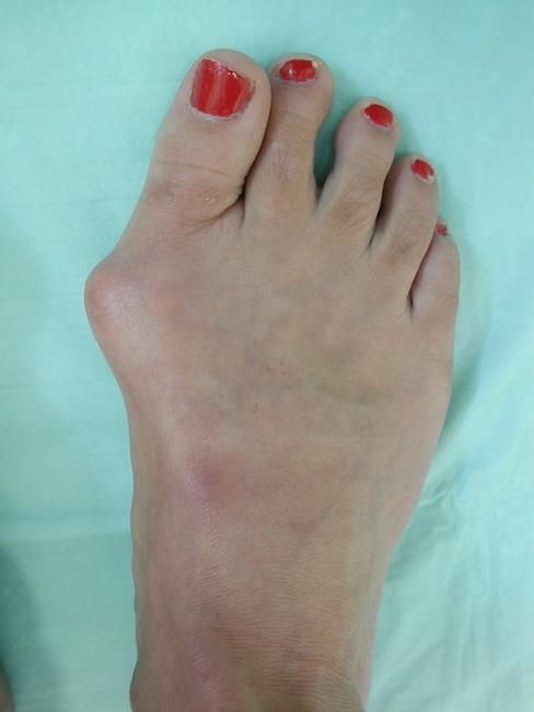 Big bad bunions