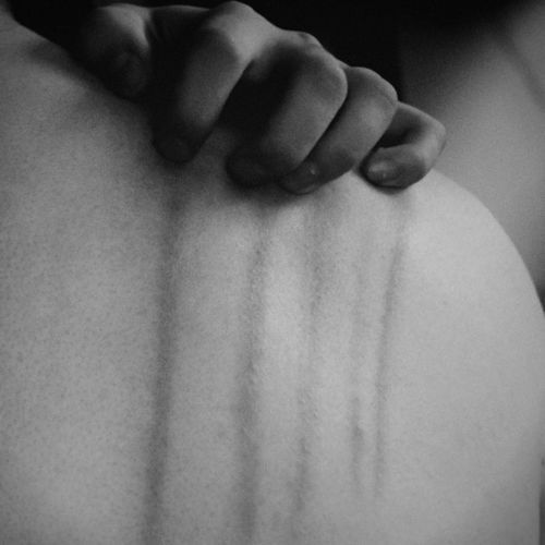My scars