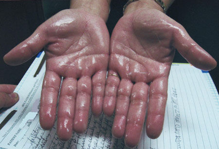 Imminent Botox injection treatment