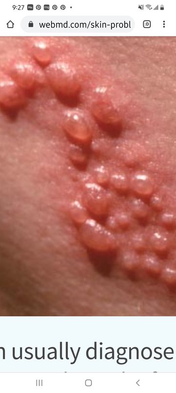 Like Shingles