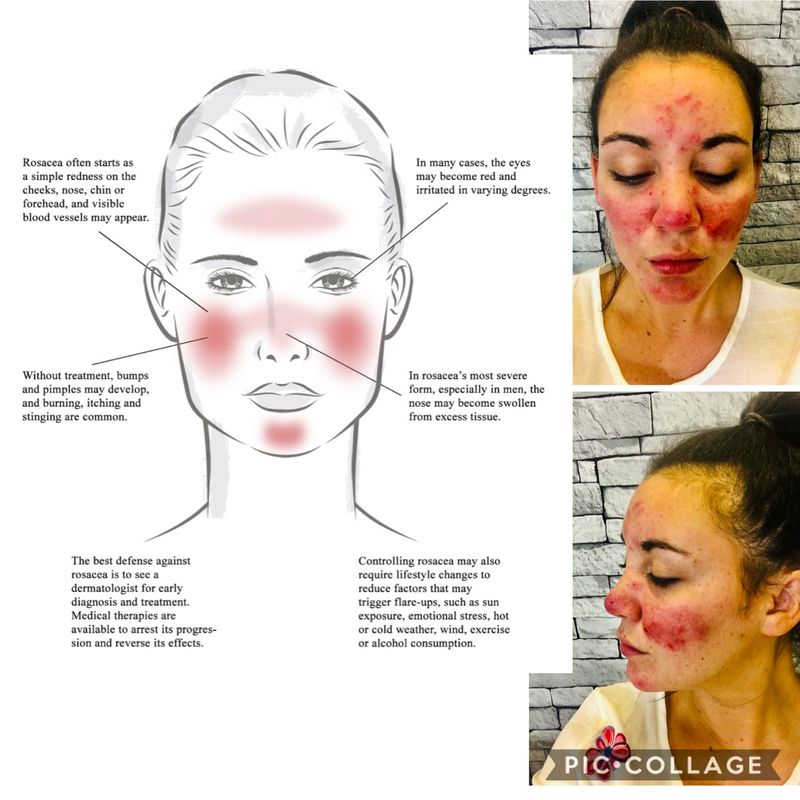 Rosacea