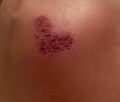 Scab Over 