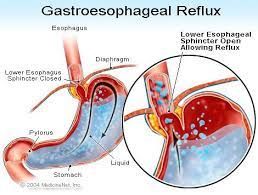 Acid reflux ~ late morning November 29th, 2021