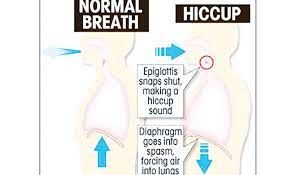 Hiccups