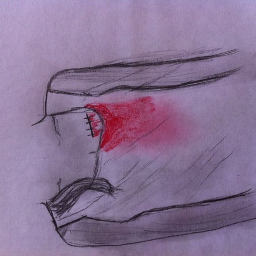 Torn heart