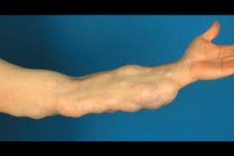 Dercums Disease Poem
