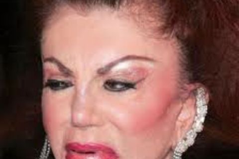 BOTTOX..ITCH !?x
