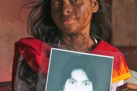 Courage and the woman who was the victim of an acid attack 