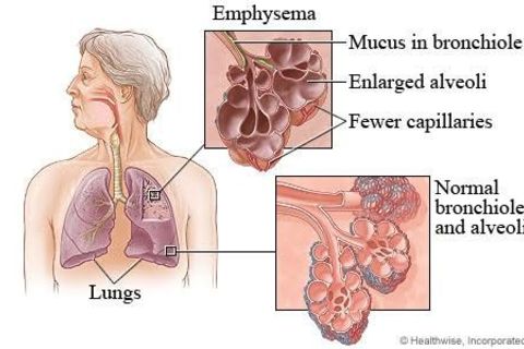 Emphysema 