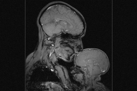 Wellbutrin in my Brain