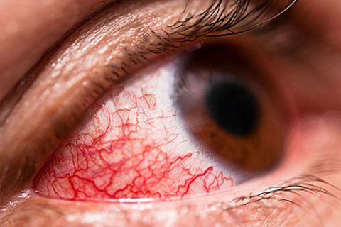 Eye-Strain