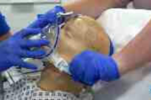 Ventilator Mask