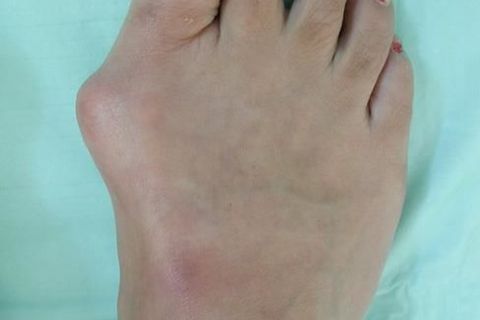 Big bad bunions