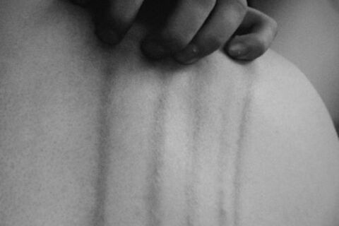 My scars