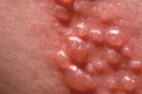 Like Shingles