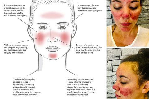 Rosacea