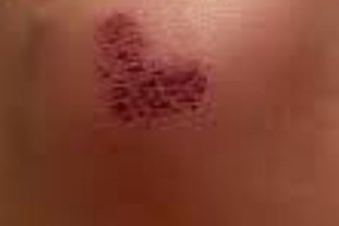 Scab Over 