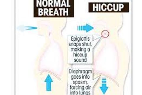Hiccups