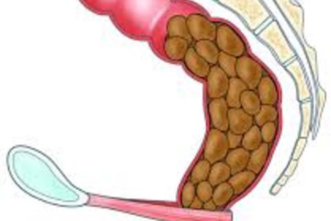 Prolonged offal bout courtesy constipation... redux revisited