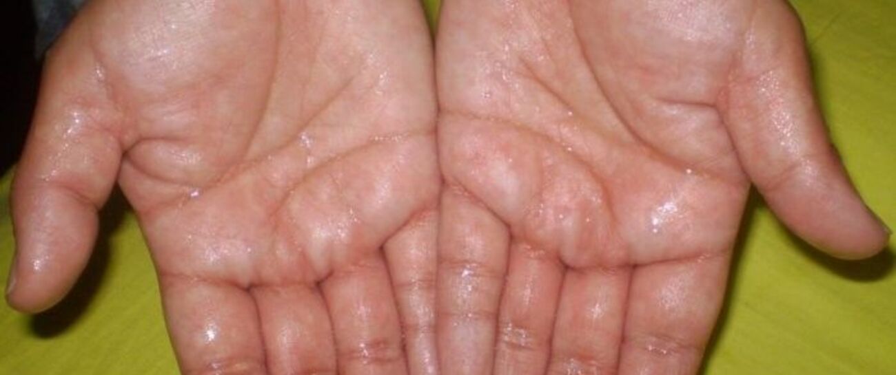 sweaty-hands-treatment-options-hyperhidrosis-network