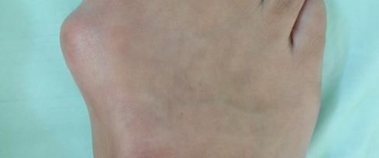 Big bad bunions