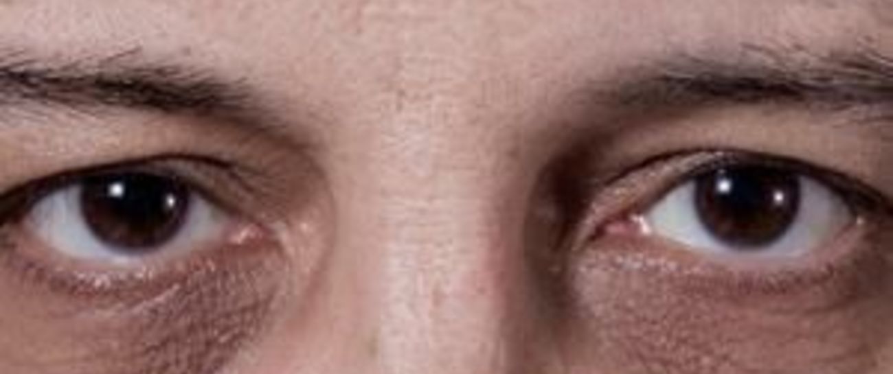 Dark Circles